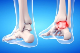 Ayak Bileği Ağrısı (2)