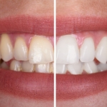 Antalya’da Sağlıklı Gülüşler İçin Doğru Adres