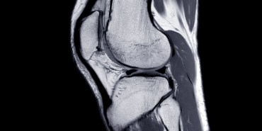 haglund deformitesi ameliyatı​ (2)